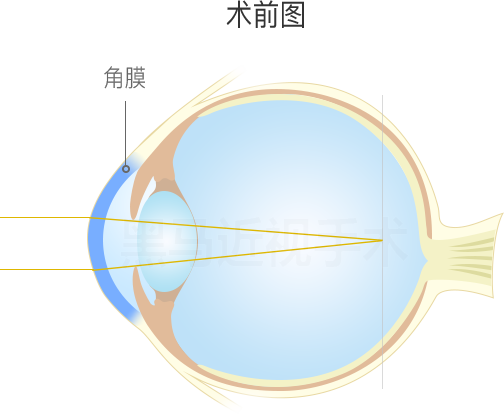 术前图