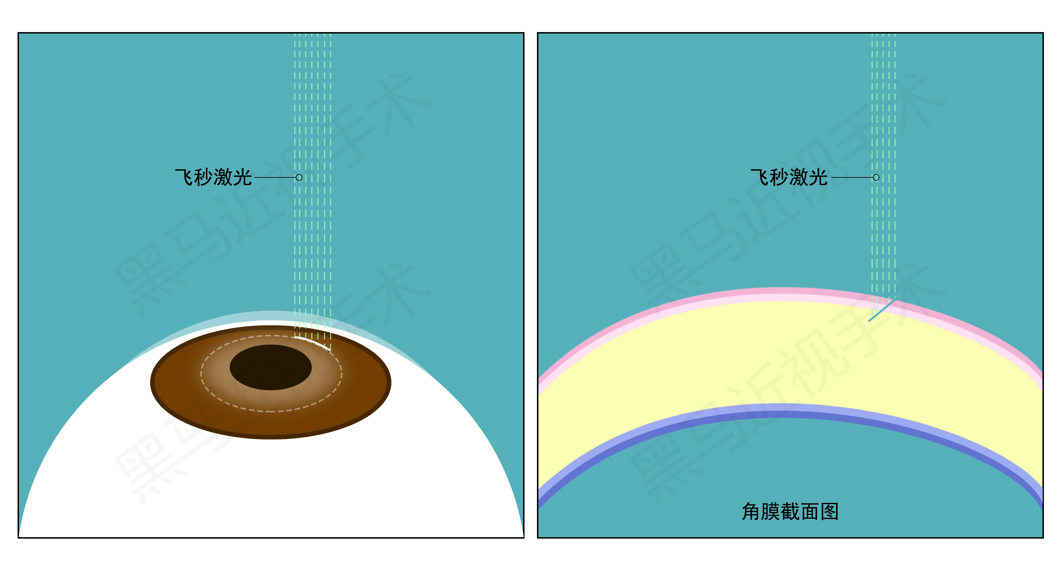 “全飞秒制瓣”/ 深圳黑马眼科