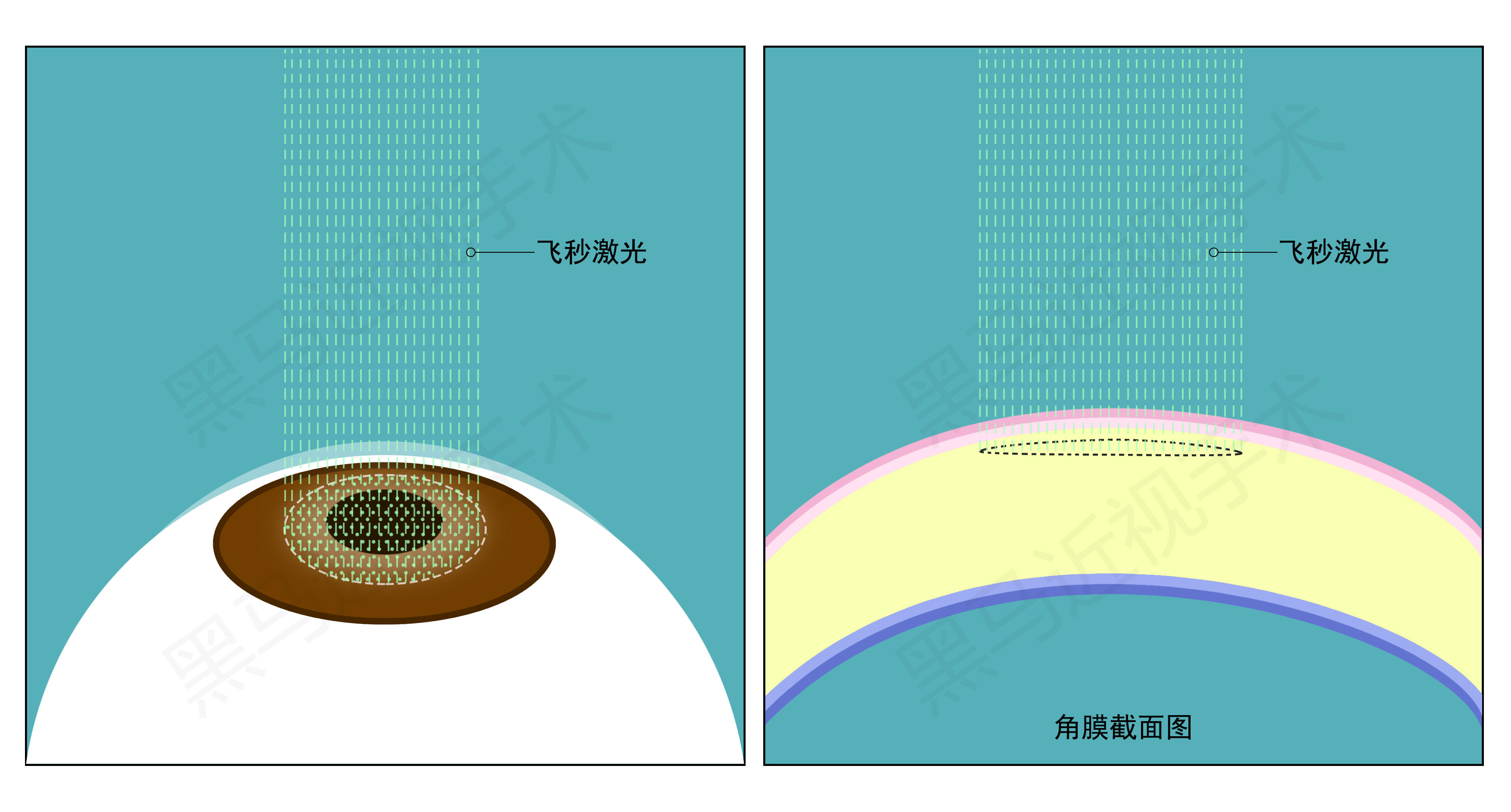“全飞秒制做切削透镜”/ 深圳黑马眼科